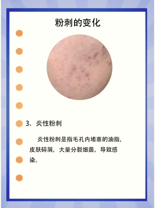 中医治疗粉刺的研究进展