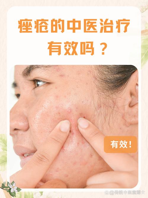 中医治疗粉刺的研究进展
